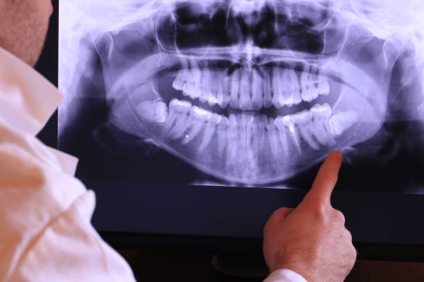 Best Knocked-Out Tooth (Avulsed Tooth) Treatment in Coopertown, TN